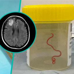 Aerzte finden Wurm in Pythons im Gehirn einer Australierin
