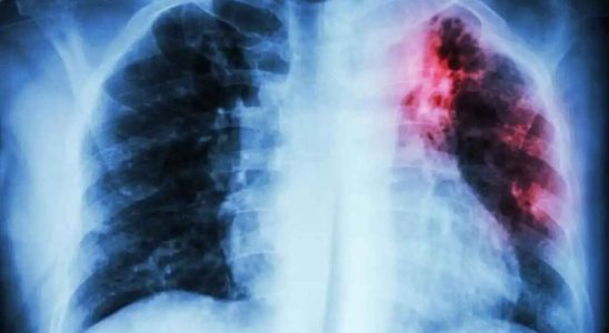pourquoi les deces dus au cancer du poumon chez les