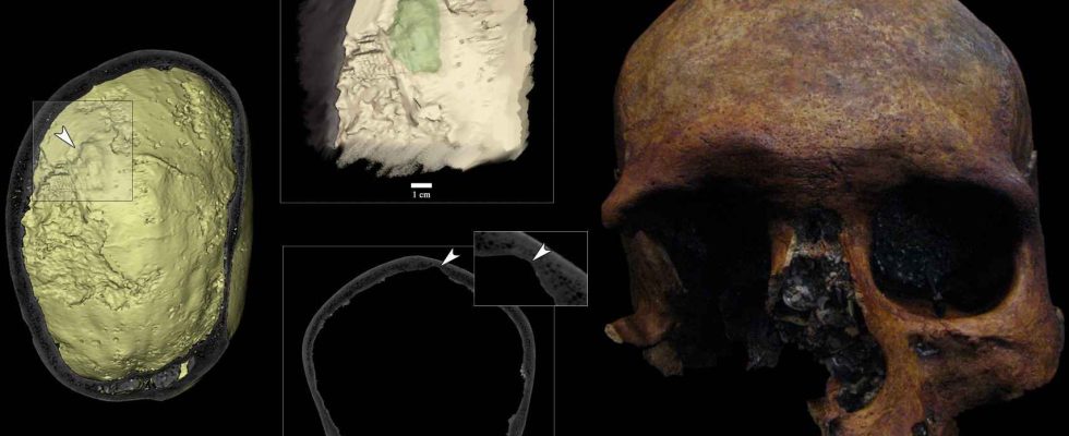 presente un cas inhabituel de tumeur cerebrale