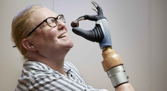 Ils creent une prothese bionique revolutionnaire qui relie les nerfs