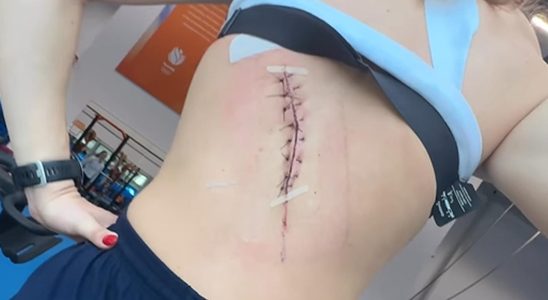 Suzanne Schulting montre une grosse blessure au dos pendant une
