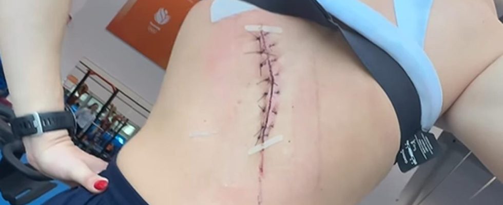 Suzanne Schulting montre une grosse blessure au dos pendant une