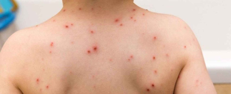 La varicelle rebondit en Espagne pour la premiere fois depuis