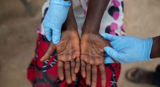 Laugmentation des cas de variole du singe au Congo declenche