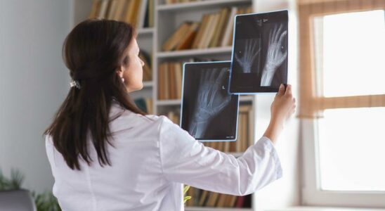 Pourquoi les femmes sont elles plus sujettes aux fractures des vertebres