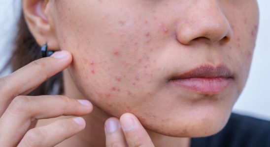 Acne reminder of the precautions to take when taking isotretinoin