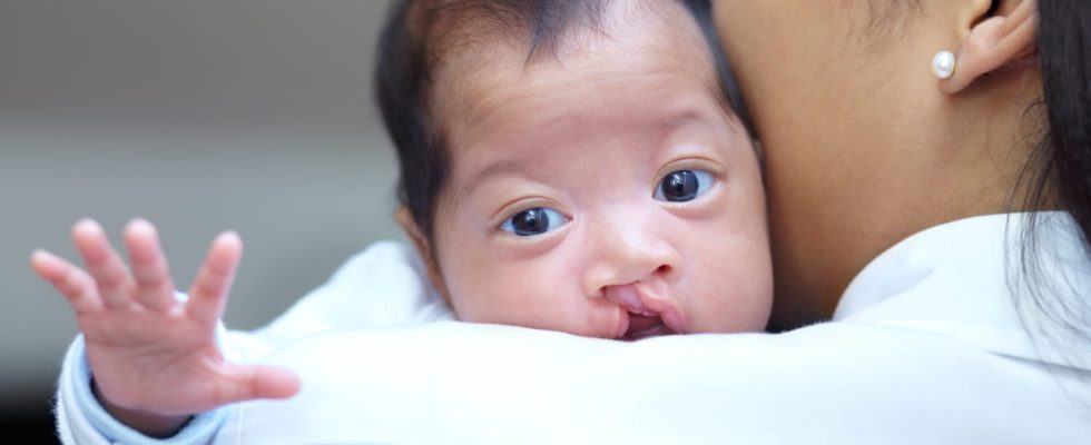 Cleft lip palate definition causes operation