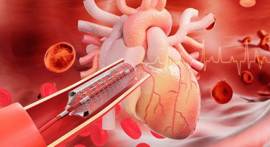 Coronarography duration stent risks when to do it