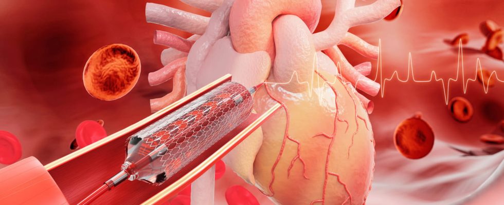 Coronarography duration stent risks when to do it