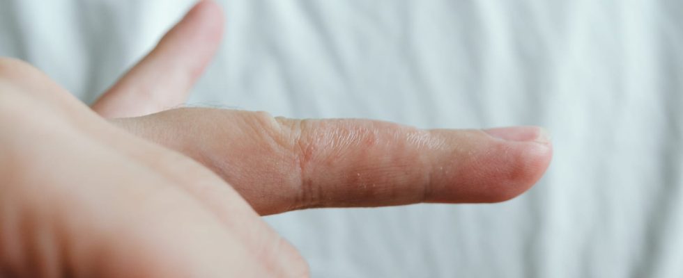 Dyshidrosis treating eczema with blisters hands feet