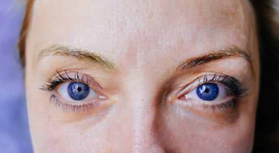 Eye stye white pimple causes contagious