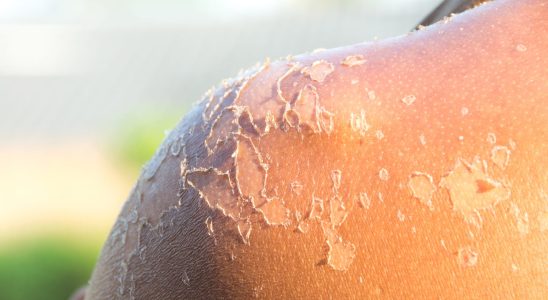 How not to peel after a sunburn Tips to avoid
