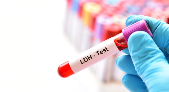 LDH high low enzyme dosage worrying