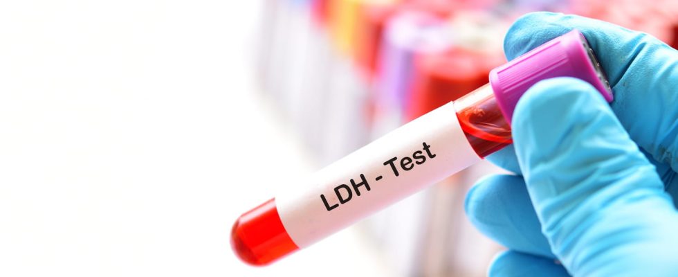 LDH high low enzyme dosage worrying