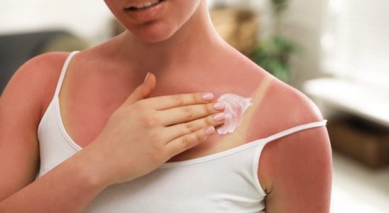These creams soothe the fire of sunburn instantly