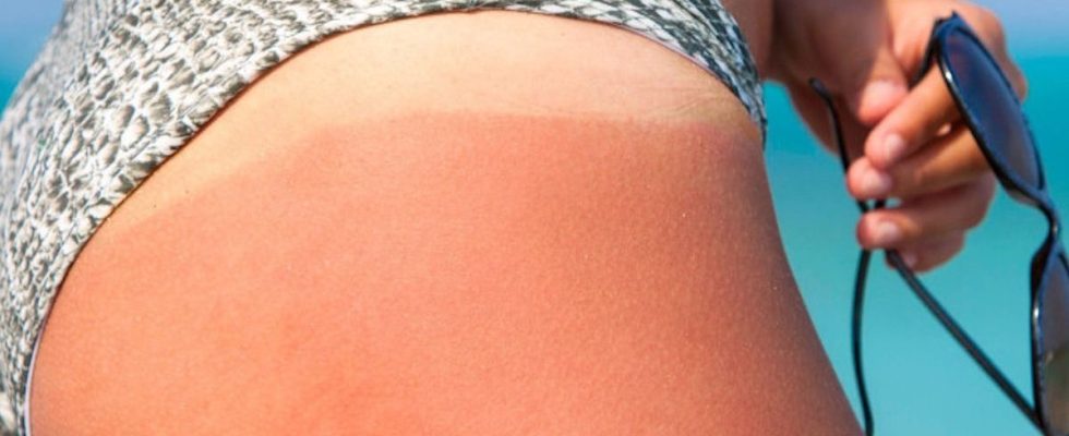 This swimsuit prevents tan lines but not sunburn