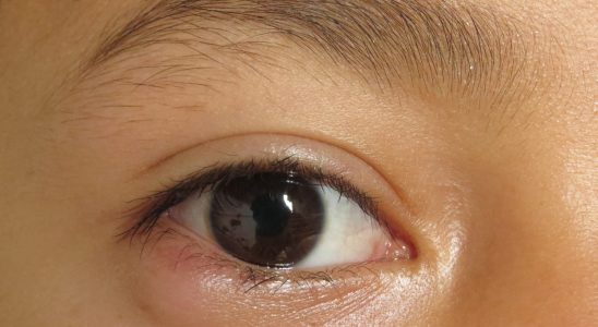 What is eye cellulite Signs and treatment