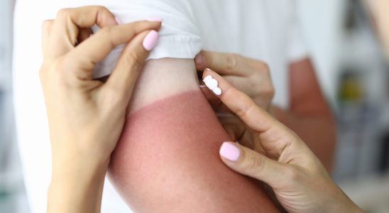 What to do in case of severe sunburn