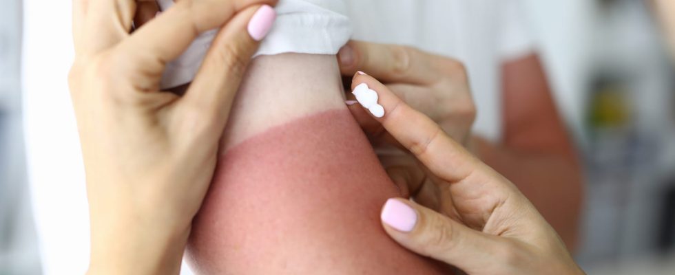 What to do in case of severe sunburn