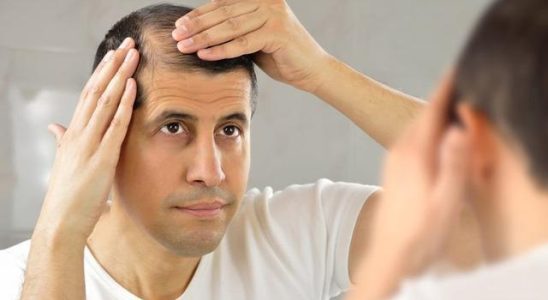 1 in 4 men goes bald before the age of