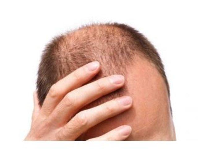 Misconceptions About Hair Loss