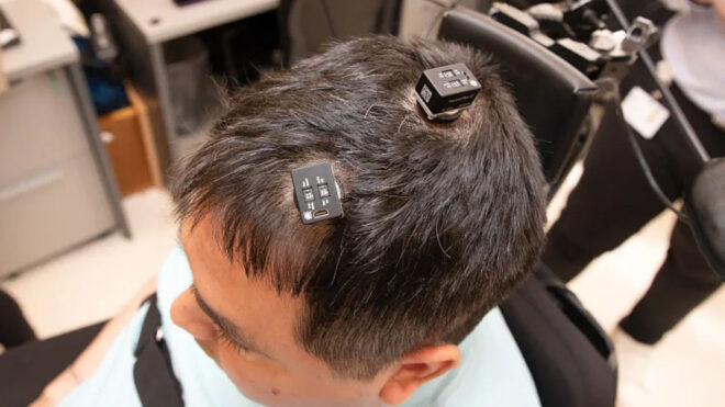 Brain implant helped a patient regain feeling