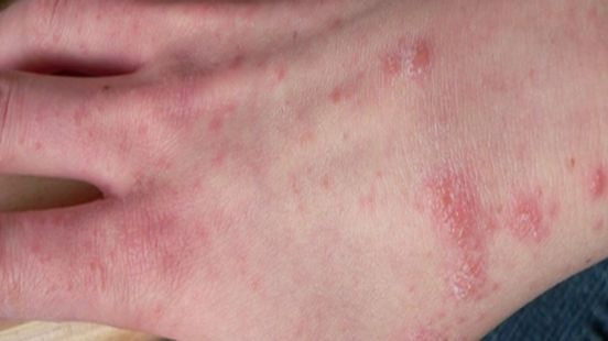 Nivel number of cases of scabies remains high