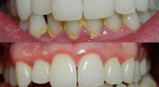 No more dental tartar and stones The most effective way