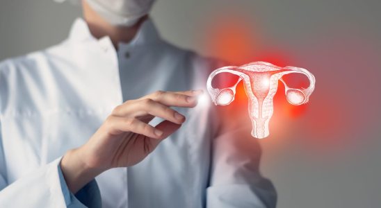 PCOS symptoms and diagnosis of polycystic ovaries
