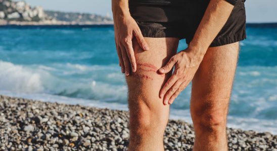 What to do immediately in case of a jellyfish sting