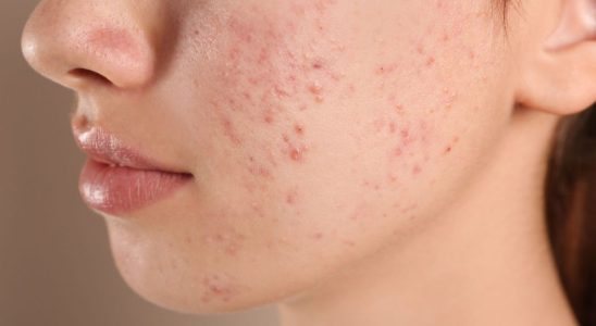 Acne would be good for your health Our expert explains