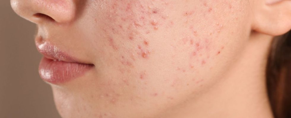 Acne would be good for your health Our expert explains