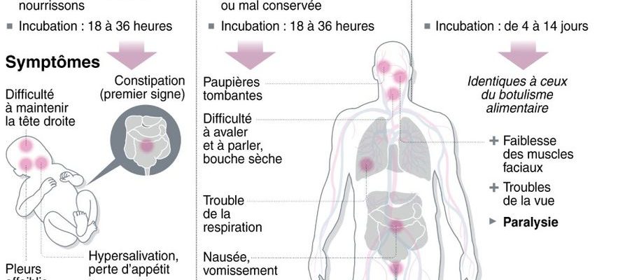 Case of botulism in Bordeaux the origin of this neurological