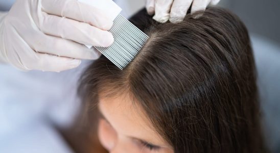 Lice are also making their comeback The right steps to