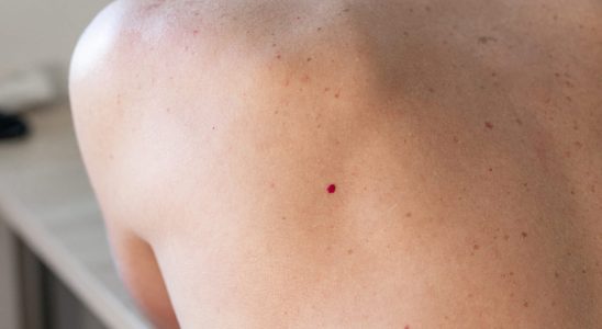 Ruby angioma causes dangerous what is it