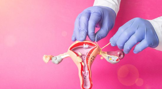 Salpingectomy when and how to remove your tubes