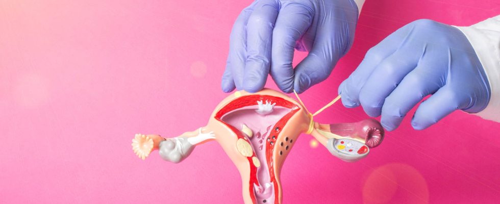Salpingectomy when and how to remove your tubes