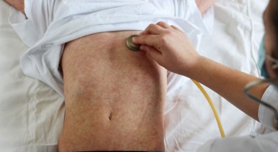54 cases of measles in Ardeche what is happening