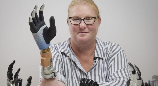 His new bionic hand directly connected to his arm gives