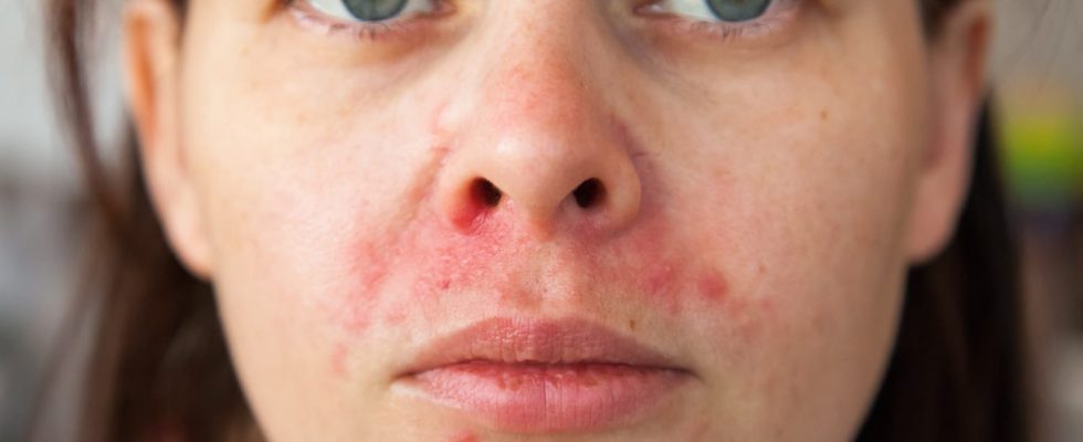 Redness around the mouth perioral dermatitis
