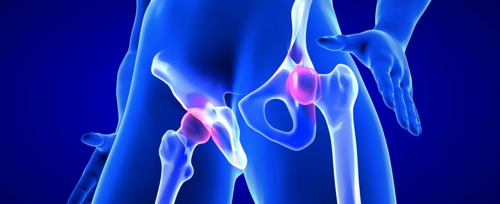 Hip fracture symptoms when to operate