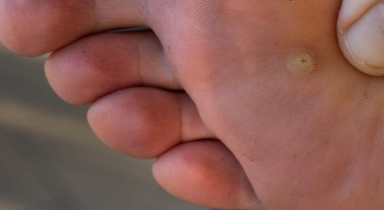Plantar wart photo dead black how to remove it