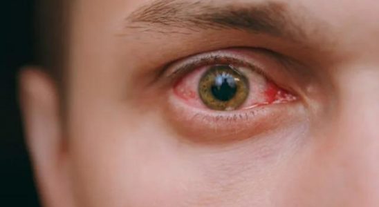 This symptom in the eyes is a warning sign of