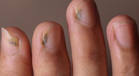 What is green nail syndrome