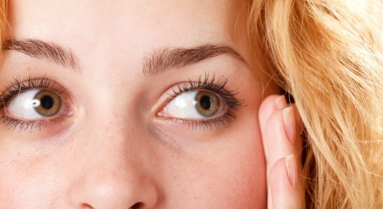 Cholesterol These signs in the eye show you have too