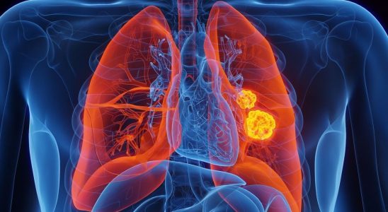 Lung cancer soon to be detectable thanks to a simple