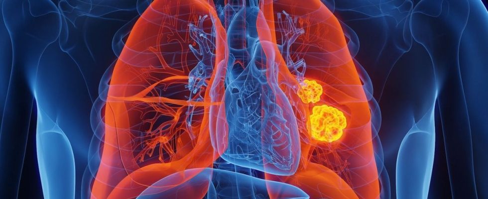 Lung cancer soon to be detectable thanks to a simple