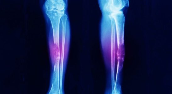 On TikTok ER doctor reveals common early symptom of bone