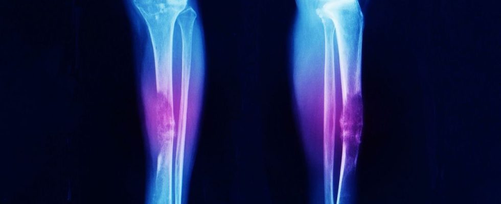 On TikTok ER doctor reveals common early symptom of bone