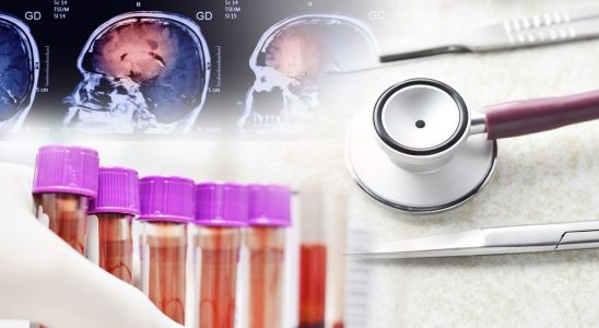 Revolutionary blood test can detect Alzheimers 15 years before symptoms